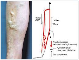 Most of the gastrocnemius muscle, together with each of the heads, are joined and inserted into the posterior surface of a wide membranous tendon. The Venous System Of The Foot Anatomy Physiology And Clinical Aspects Servier Phlebolymphologyservier Phlebolymphology