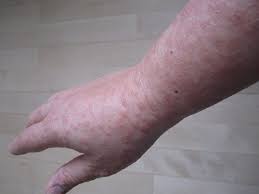 Puppp Rash And How To Treat It Quickly Twiniversity 1 Twin Pregnancy Site