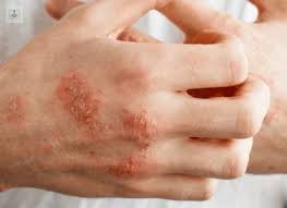 Image result for dermatitis contacta allergica