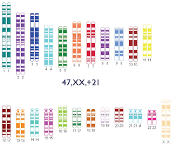 It occurs when two acrocentric chromosomes fuse. Trisomie 21 Alles Uber Das Down Syndrom
