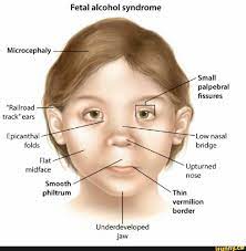 My 19 m.o has epicanthal folds and flat nasal bridge but no other physical signs of ds. Fetal Alcohol Syndrome Microcephaly Small Palpebral Fissures Railroad Track Ears Epicanthal Low Nasal Folds Bridge Flat Midface Upturned Nose Smooth Philtrum Thin Vermilion Border Underdeveloped Jaw Ifunny