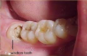 Avoid dry socket with wisdom tooth extractions south hills dental clinic. Wisdom Teeth Removal Decatur Georgia Wisdom Tooth Extraction Dekalb County Ga
