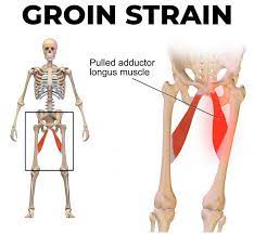 In human anatomy, the groin (the adjective is inguinal, as in inguinal canal) is the junctional area (also known as the inguinal region) between the abdomen and the thigh1 on either side of the a pulled groin muscle usually refers to a painful injury sustained by straining the hip adductor muscles.3. Groin Strain Causes Symptoms Diagnosis Treatment Exercises Recovery Time