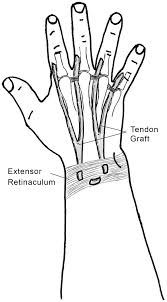 Flexor digitorum superficialis (fds) is located in the superficial and flexor digitorum profundus (fdp) in the deep layer of the anterior compartment of the forearm; Tendon Transfers Part Ii Transfers For Ulnar Nerve Palsy And Median Nerve Palsy Abstract Europe Pmc