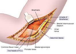 Carpal and cubital tunnel surgery incisions will seal in 5 days and the functional recovery may take 2 to 3 weeks before returning to work. Cubital Tunnel Syndrome Physiopedia