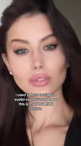 No Upper Eyelid Exposure