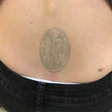 Brian zelickson, md board certified dermatologist. Laser Tattoo Removal Minneapolis Mn Removery