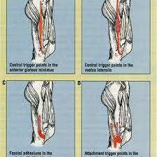 Pdf Quick Solutions For Iliotibial Band Syndrome