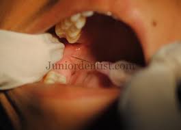 Why Cannot The Dentist Get My Teeth Numb With Local Anesthesia