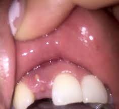 White Bump On Gums After Dental Implant Photos