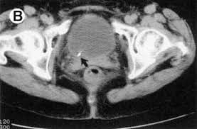 How long does it take? What Is The Role Of Ct Scanning In The Diagnosis Of Nephrolithiasis