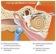 Meniere S Disease Causes Symptoms Treatments