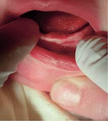 Image result for Neonatal Teeth