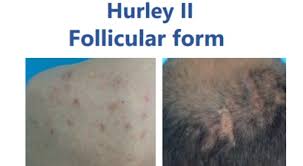 hidradenitis suppurativa nin tedavisi