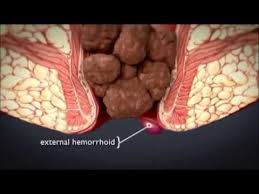 How to treat internal hemorrhoids. 5 7 Hemorrhoids Medicine Libretexts