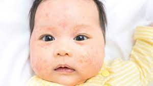 Mengandung kebaikan susu kambing yang bergizi dan mampu memenuhi keperluan perkembangan si kecil. Mengapa Bayi Mengalami Eczema Kumparan Com