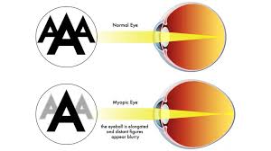 Image result for Refractive Error