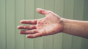A pharmacist can help with hand, foot and mouth disease. Hand Foot And Mouth Disease Symptoms Prevention Hfmd Treatment Michigan Medicine