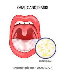 Image result for Candidiasis