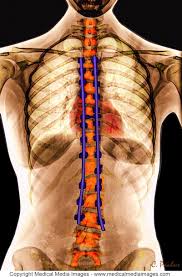 A Spine Fusion Surgery Which Was Performed To Straighten A Scoliosis The Metal Rods And Screws Are Shown In Blue Id Escoliosis Dispositivos Medicos Patologia