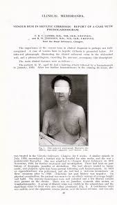 Image result for Venous Hum