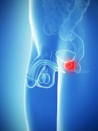 What are the symptoms of testicular cancer? Testicular Cancer Dull Aches May Be A Sign You Have The Condition Express Co Uk