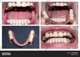 This patient was dissatisfied with the looks of her worn and discolored metal based partial denture. Dental Rehabilitation Image Photo Free Trial Bigstock