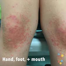 What are the symptoms of hand, foot and mouth disease? Hand Foot And Mouth Skin Deep