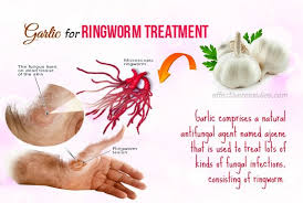 15 Best Natural Home Remedies For Ringworm In Humans Home Remedies For Ringworm Natural Antifungal Get Rid Of Ringworm