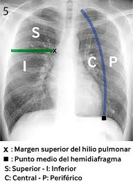 The most common one is streptococcus (pneumococcus), but other bacteria can cause it too. Radiologia En La Pandemia Covid 19 Uso Actual Recomendaciones Para La Estructuracion Del Informe Radiologico Y Experiencia De Nuestro Departamento