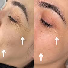 SkinPen Microneedling, Hyperpigmentation Treatment