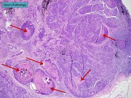 Ductal Carcinoma Panosundaki Pin