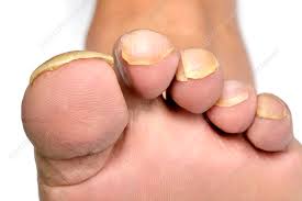 Image result for Clubbing nails feet