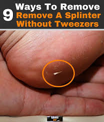 9 Ways To Painlessly Remove A Splinter Without Tweezers Splinter Removal How To Remove Cleaning Hacks