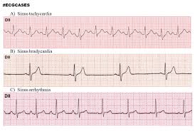 Sinus Tachycardia Vs Sinus Bradycardia Vs Sinus Arrhythmia