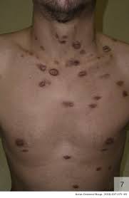 Hiv (human immunodeficiency virus) destroys important cells that fight disease and infection, which weakens a person's immune system. Atypical Cutaneous Manifestations In Syphilis Actas Dermo Sifiliograficas