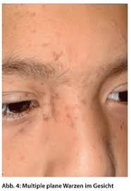 Other hpv types are responsible for benign common skin warts that are not associated with cancer. Warzen So Schwanden Warzen Bei Kindern Doctors Today