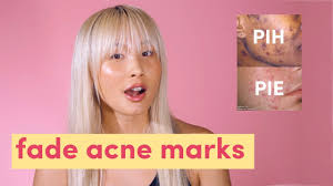How to get rid of pih. Fade Acne Marks Post Inflammatory Hyperpigmentation Post Inflammatory Erythema Pih Pie Youtube