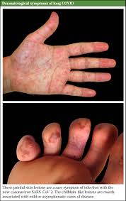 People infected have had an illness that has ranged from mild (like a common cold) to severe requiring individuals to be hospitalized. Managing The Long Term Effects Of Covid 19 The Pharmaceutical Journal