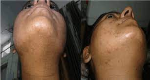 Check out our laser hair removal page. An Ideal Laser For Hair Reduction In Ethnic Skin