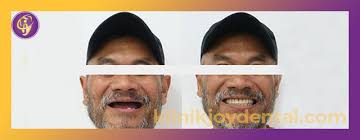Gigi palsu, crown gigi, implan atau gigi tiruan merupakan layanan global estetik dental care untuk mengembalikan fungsi gigi dalam kehidupan seperti untuk berbicara lebih nyaman dan makan lebih. Pertimbangan Memilih Gigi Palsu Klinik Gigi Joy Dental