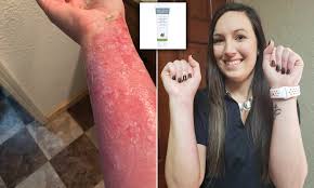 Maybe you would like to learn more about one of these? Woman 28 Who Suffered Severe Burns When Pressure Cooker Exploded Has Been Healed By 8 Milk Udder Cream Daily Mail Online