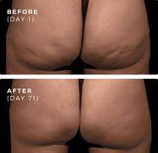 They do work if you are taking it in correct way. Qwo In New York City I Cellulite Treatment Nyc Icellulite Reduction Nyc