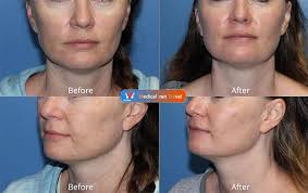 Maybe you would like to learn more about one of these? Microneedling In Iran Procedure Results Cost Mitramed