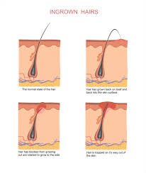 Sound like infected follicle, if it becomes an abscess need to be drained, otherwise may need antibiotic, some times it may resolve on its own,. Infected Ingrown Hair Causes And Treatment All Beauty Today