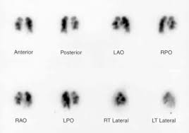 L'embolia polmonare è così chiamata perché il protagonista dell'ostruzione è un embolo. Embolia Polmonare Malattie Polmonari Manuali Msd Edizione Professionisti