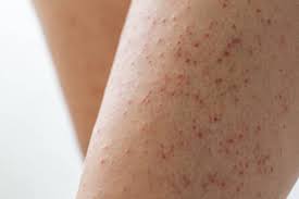 Image result for liver spots on legs
