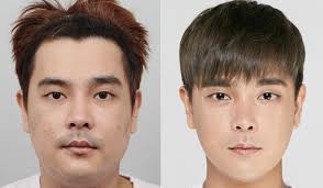 This cosmetic surgery is known in the medical community as rhinoplasty and is a surgical method for altering the length, shape, or contour of the nose. Male Cosmetic Surgery In China Men Do It To Get A Job Find A Date Or Feel More Confident Today
