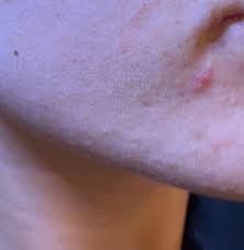 A comedo can be open (blackhead) or closed by skin (whitehead) and occur with or without acne. Hyfrecation And Cautery Of Comedones Dr Sajjad Rajpar