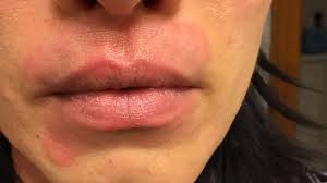 Image result for ekzema face